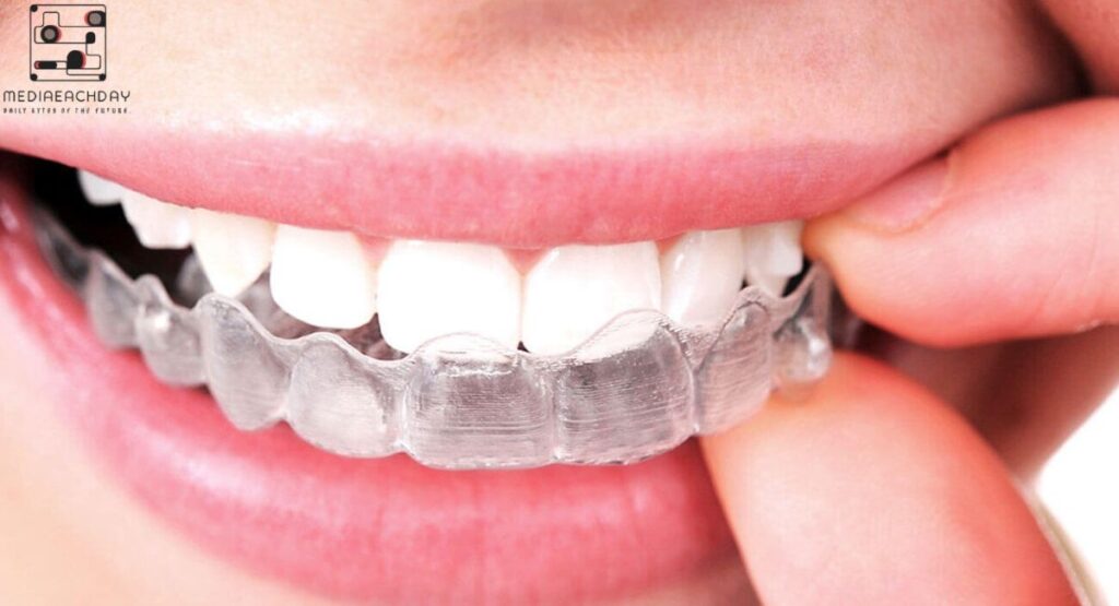 does invisalign change face shape