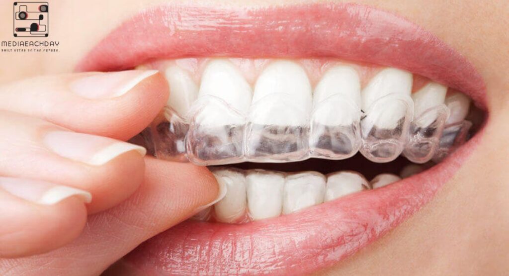 does invisalign change face shape